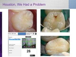 New Technologies in Caries Diagnosis: The Canary System in Pediatric ...