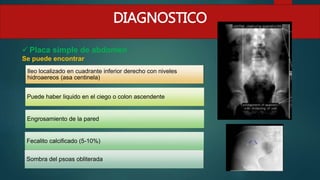  Placa simple de abdomen
Se puede encontrar
Ileo localizado en cuadrante inferior derecho con niveles
hidroaereos (asa centinela)
Puede haber liquido en el ciego o colon ascendente
Engrosamiento de la pared
Fecalito calcificado (5-10%)
Sombra del psoas obliterada
DIAGNOSTICO
 