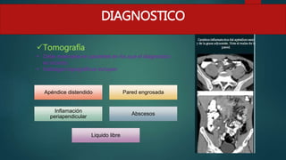Tomografía
 Debe reservarse en pacientes en los que el diagnostico
es incierto
 Hallazgos topográficos incluyen
Apéndice distendido Pared engrosada
Inflamación
periapendicular
Abscesos
Liquido libre
DIAGNOSTICO
 