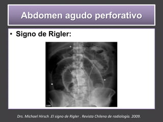 Abdomen agudo perforativo | PPTX
