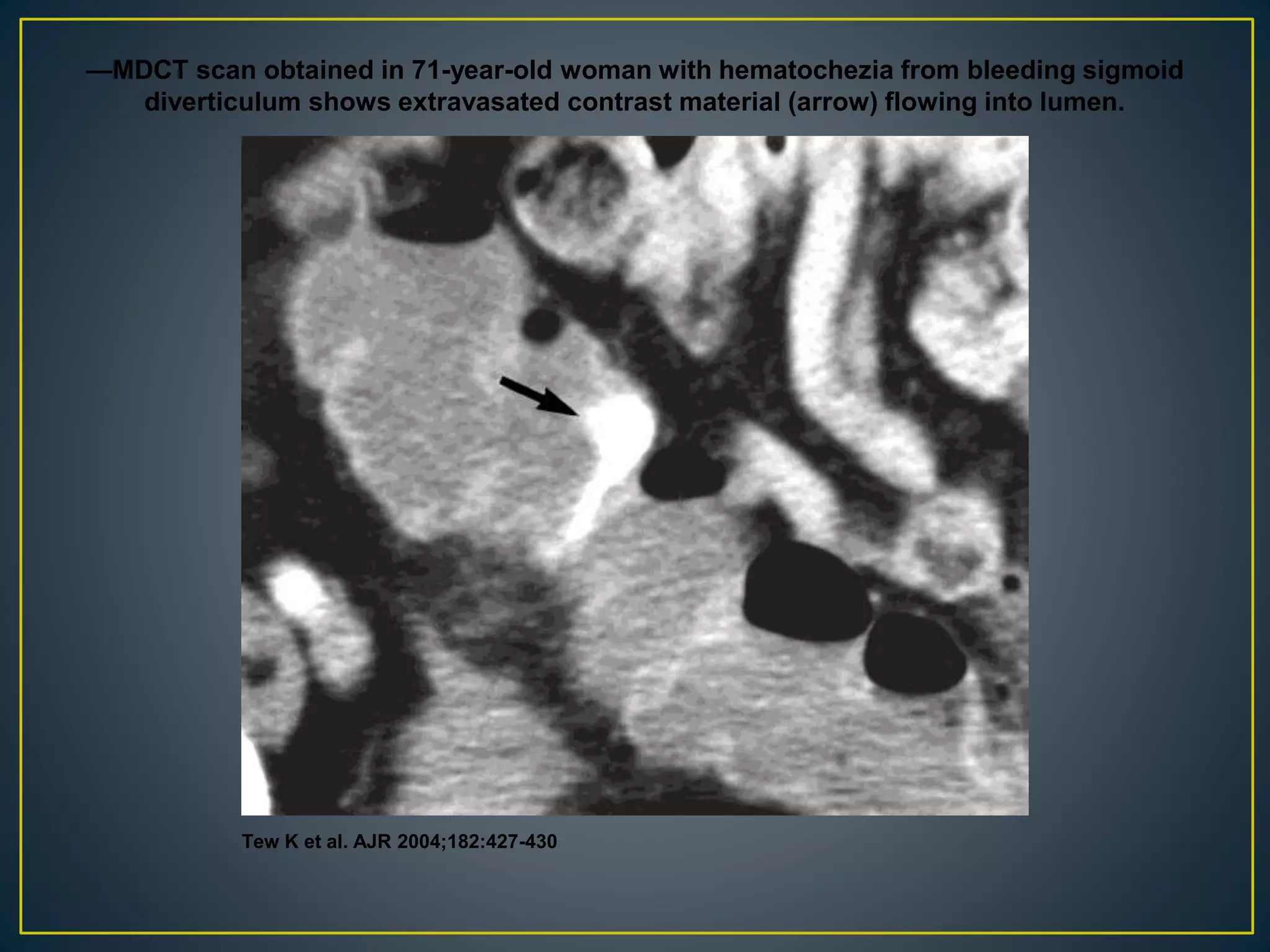 —MDCT scan obtained in 71-year-old woman with hematochezia from bleeding sigmoid
diverticulum shows extravasated contrast material (arrow) flowing into lumen.
Tew K et al. AJR 2004;182:427-430
 