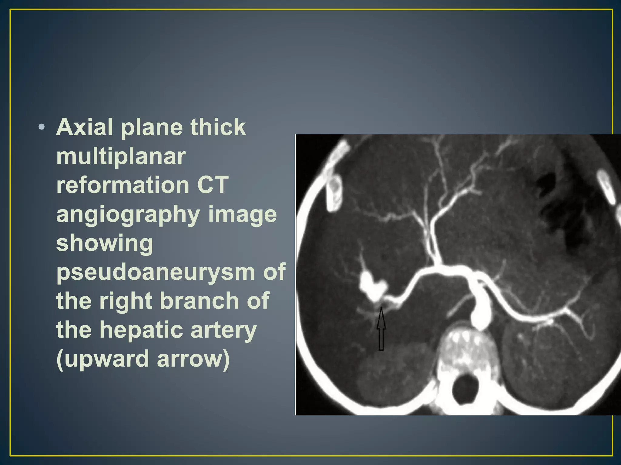 • Axial plane thick
multiplanar
reformation CT
angiography image
showing
pseudoaneurysm of
the right branch of
the hepatic artery
(upward arrow)
 