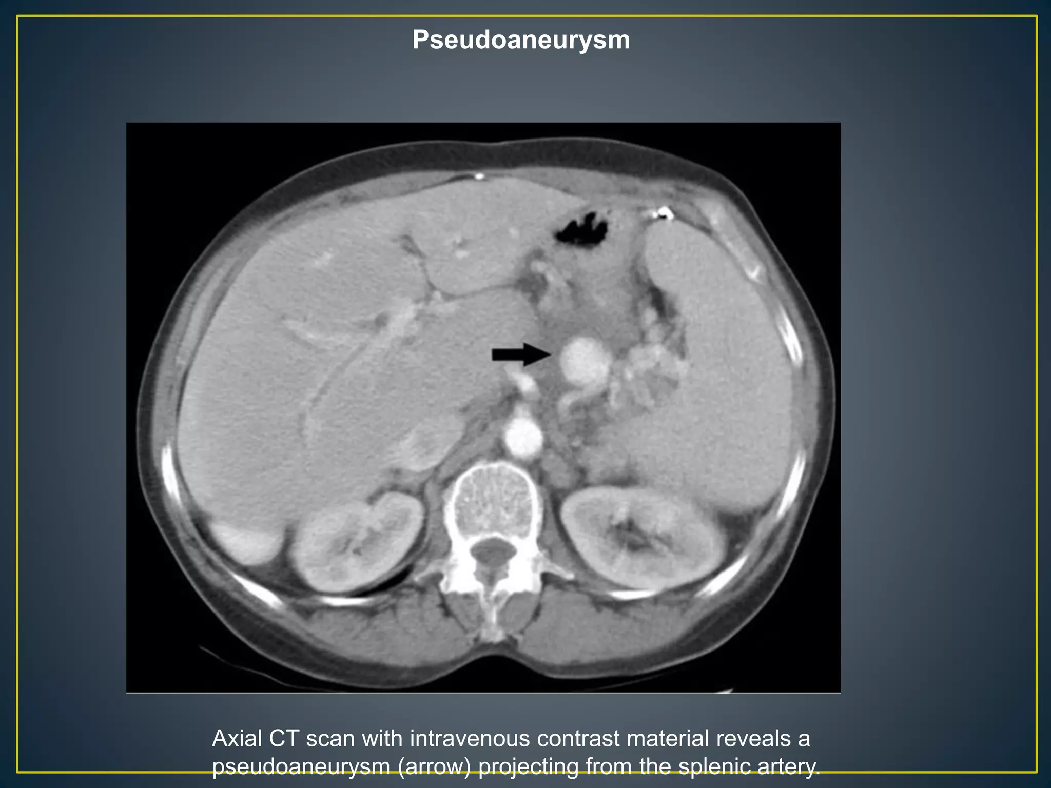 Axial CT scan with intravenous contrast material reveals a
pseudoaneurysm (arrow) projecting from the splenic artery.
Pseudoaneurysm
 