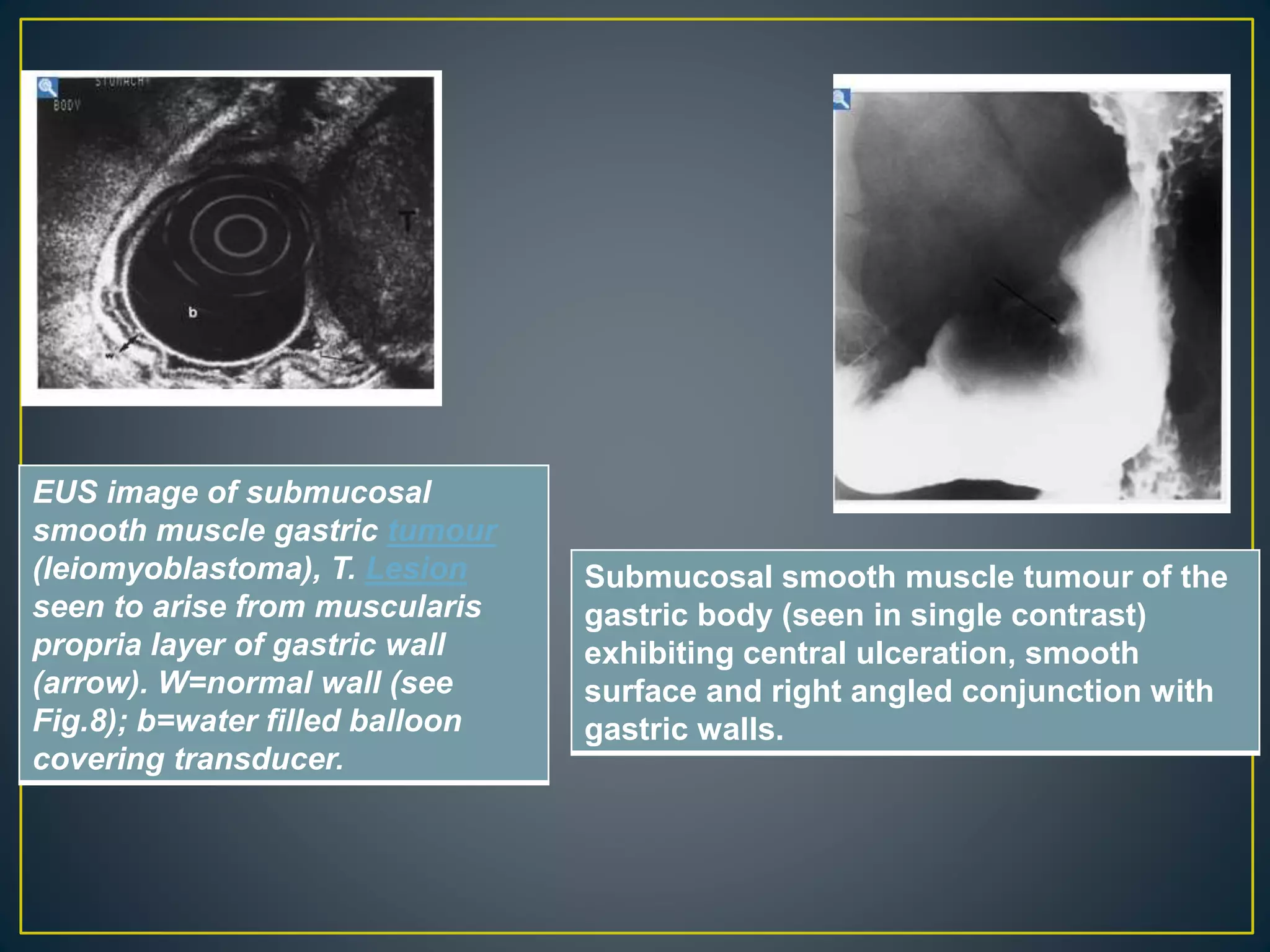 EUS image of submucosal
smooth muscle gastric tumour
(leiomyoblastoma), T. Lesion
seen to arise from muscularis
propria layer of gastric wall
(arrow). W=normal wall (see
Fig.8); b=water filled balloon
covering transducer.
Submucosal smooth muscle tumour of the
gastric body (seen in single contrast)
exhibiting central ulceration, smooth
surface and right angled conjunction with
gastric walls.
 