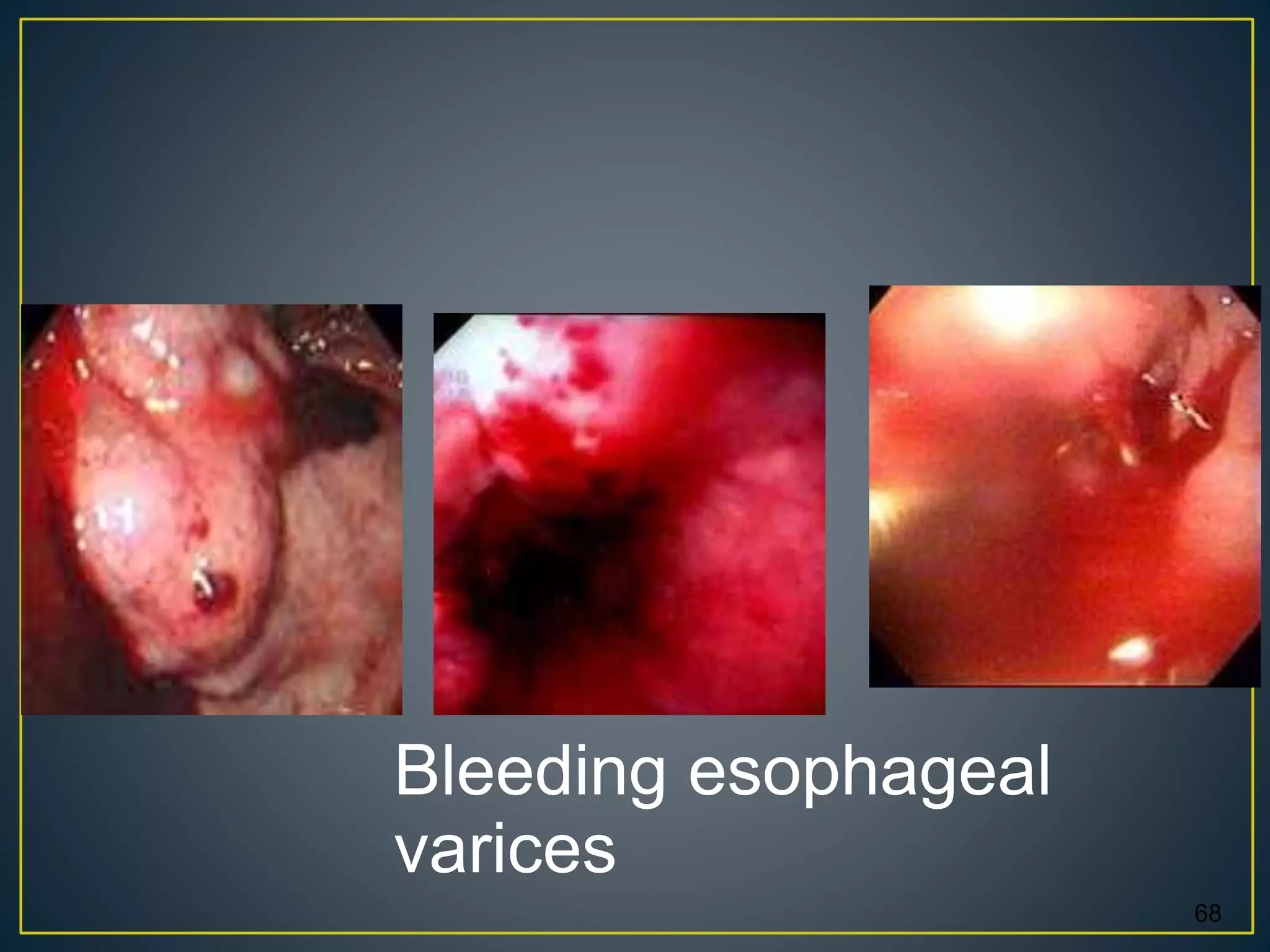 Bleeding esophageal
varices
68
 