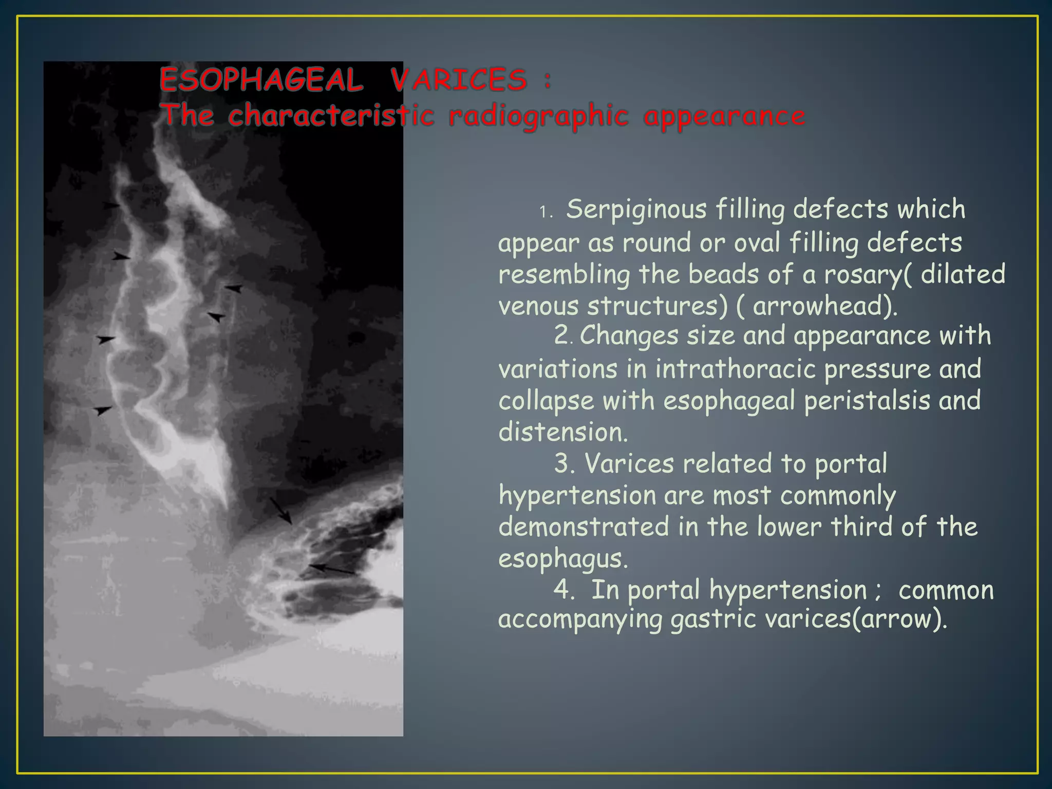 1. Serpiginous filling defects which
appear as round or oval filling defects
resembling the beads of a rosary( dilated
venous structures) ( arrowhead).
2. Changes size and appearance with
variations in intrathoracic pressure and
collapse with esophageal peristalsis and
distension.
3. Varices related to portal
hypertension are most commonly
demonstrated in the lower third of the
esophagus.
4. In portal hypertension ; common
accompanying gastric varices(arrow).
 