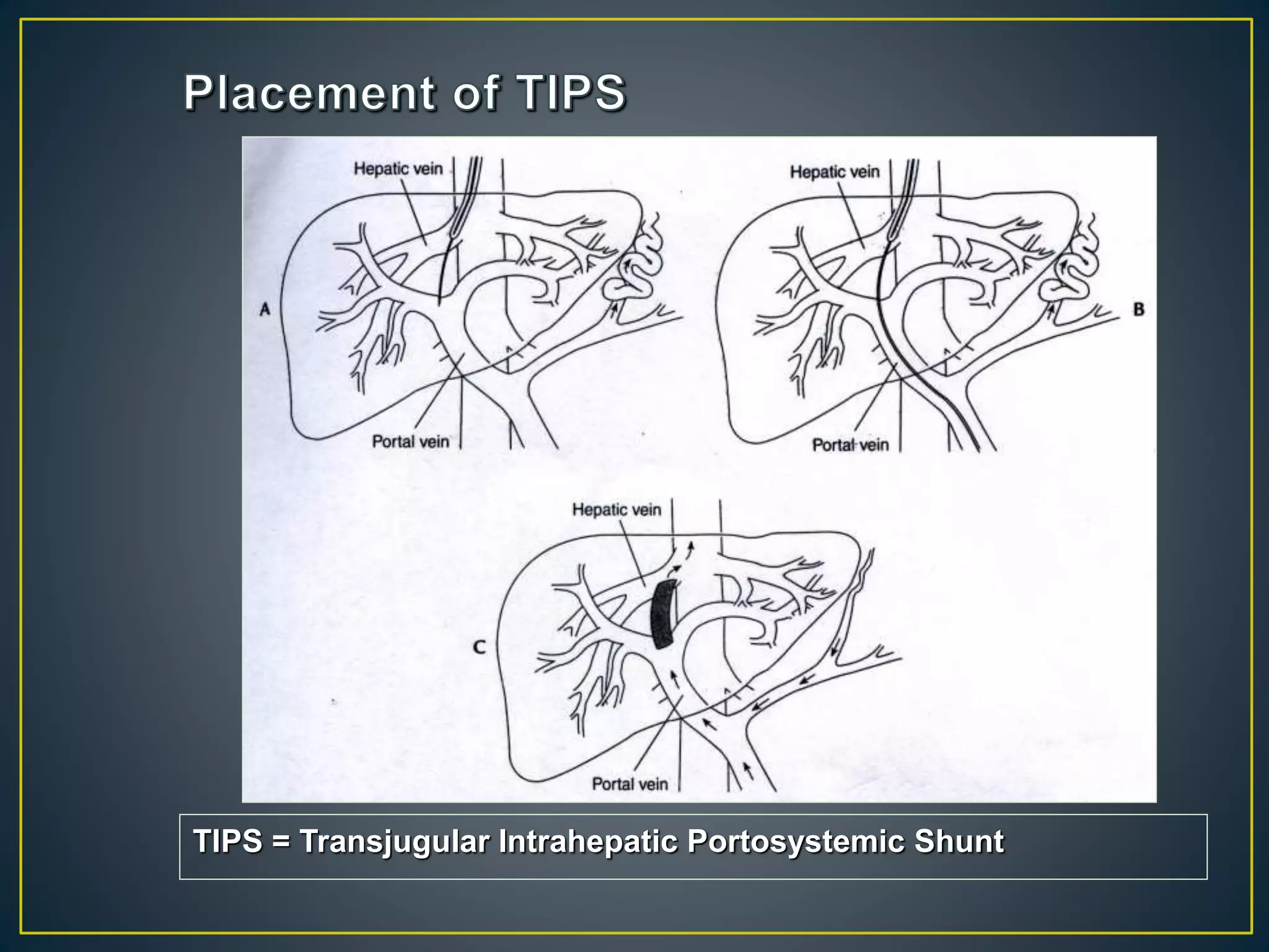 TIPS = Transjugular Intrahepatic Portosystemic Shunt
 
