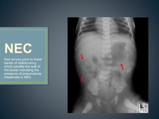 Red arrows point to linear
bands of radiolucency
which parallel the wall of
the bowel indicating the
presence of pneumatosis
intestinalis in NEC
 