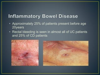 • Approximately 25% of patients present before age
20years
• Rectal bleeding is seen in almost all of UC patients
and 25% of CD patients
 