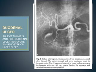 RULE OF THUMB IS
ANTERIOR DUODENAL
ULCER PERFORATE
WHILE POSTERIOR
ULCER BLEED
 