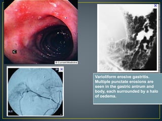 Varioliform erosive gastritis.
Multiple punctate erosions are
seen in the gastric antrum and
body, each surrounded by a halo
of oedema.
 