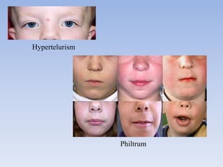 Hypertelurism
Philtrum
 