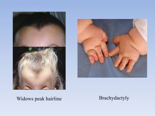 BrachydactylyWidows peak hairline
 