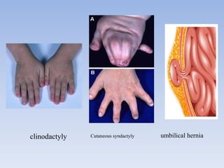 clinodactyly Cutaneous syndactyly umbilical hernia
 