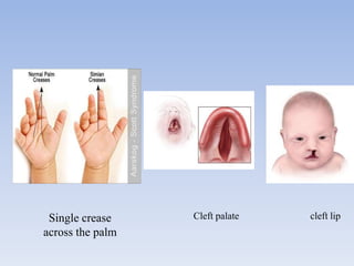 Cleft palate cleft lipSingle crease
across the palm
 