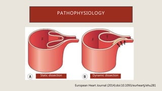 PATHOPHYSIOLOGY
Static dissection Dynamic dissection
European Heart Journal (2014):doi:10.1093/eurheartj/ehu281
 