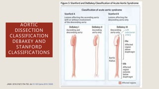 AORTIC
DISSECTION
CLASSIFICATION
DEBAKEY AND
STANFORD
CLASSIFICATIONS
JAMA. 2016;316(7):754-763. doi:10.1001/jama.2016.10026
 