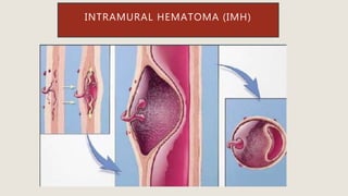 INTRAMURAL HEMATOMA (IMH)
 