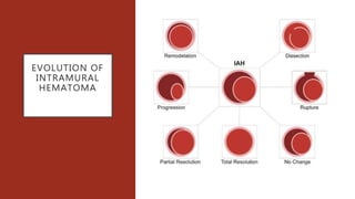 EVOLUTION OF
INTRAMURAL
HEMATOMA
 