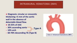 ● Diagnosis: circular or crescentic
thickening >5 mm of the aortic
wall in the absence of
detectable blood flow.
● 10-25% of AAS
– 30% ascending aorta
– 10% arch
– 60-70% descending TA (Type B)
INTRAMURAL HEMATOMA (IMH)
Type A
 