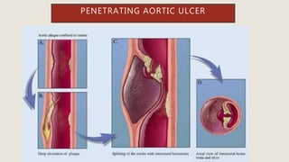 PENETRATING AORTIC ULCER
 