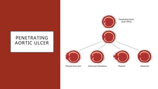 PENETRATING
AORTIC ULCER
 