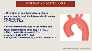 • ● Ulceration of an atherosclerotic plaque
penetrating through the internal elastic lamina
into the media.
● 2-7% of all AAS.
● Most commonly located in the middle and
lower distal thoracic aorta (type-B PAU).
● Elderly patients, smokers, HTN,
associated CAD, COPD, AAA
● Diagnosis → unenhanced/contrast enhanced CT
PENETRATING AORTIC ULCER
JAMA. 2016;316(7):754-763. doi:10.1001/jama.2016.10026
 