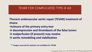 TEVAR FOR COMPLICATED TYPE-B AD
Thoracic endovascular aortic repair (TEVAR) treatment of
choice
→closure of the primary entry tear
→ decompression and thrombosis of the false lumen
→ malperfusion (if present) may resolve
→ aortic remodeling and stabilization
** Surgery reserved for patients not candidate for TEVAR
European Heart Journal (2014):doi:10.1093/eurheartj/ehu28
 