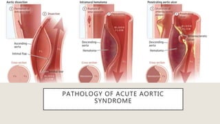 PATHOLOGY OF ACUTE AORTIC
SYNDROME
 