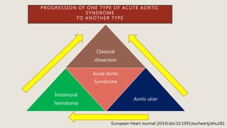 PROGRESSION OF ONE TYPE OF ACUTE AORTIC
SYNDROME
TO ANOTHER TYPE
Classical
dissection
Intramural
hematoma
Acute Aortic
Synrdrome
Aortic ulcer
European Heart Journal (2014):doi:10.1093/eurheartj/ehu281
 