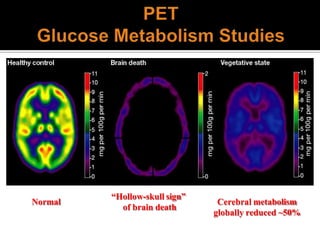 “Hollow-skull sign”
of brain death
Cerebral metabolism
globally reduced ~50%
Normal
 