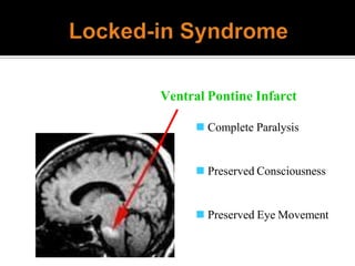 Ventral Pontine Infarct
 Complete Paralysis
 Preserved Consciousness
 Preserved Eye Movement
 