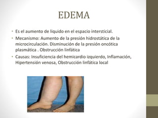 EDEMA
• Es el aumento de liquido en el espacio intersticial.
• Mecanismo: Aumento de la presión hidrostática de la
microcirculación. Disminución de la presión oncótica
plasmática . Obstrucción linfática
• Causas: Insuficiencia del hemicardio izquierdo, Inflamación,
Hipertensión venosa, Obstrucción linfática local
 