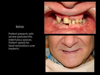 Before
Patient presents with
severe periodontitis,
edentulous spaces.
Patient opted for
fixed restorations over
implants.
 