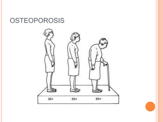 OSTEOPOROSIS
 