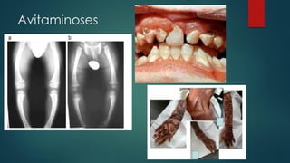 Avitaminoses
 