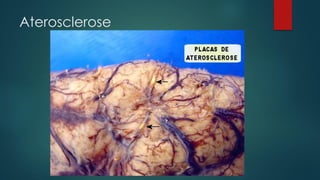 Aterosclerose
 