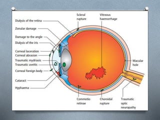eye trauma approach and management | PPTX