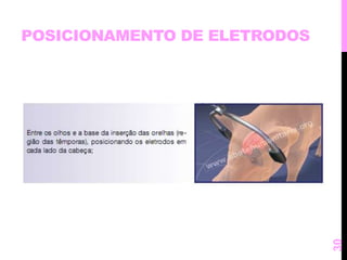 POSICIONAMENTO DE ELETRODOS 
30 
 