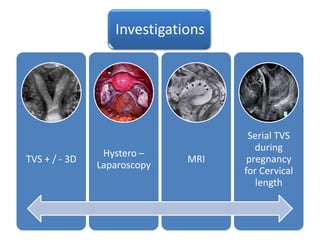 Investigations




                                    Serial TVS
                                      during
                Hystero –
TVS + / - 3D                 MRI    pregnancy
               Laparoscopy
                                   for Cervical
                                      length
 