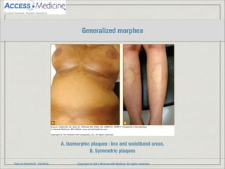 Date of download: 3/4/2014 Copyright © 2012 McGraw-Hill Medical. All rights reserved.
A. Isomorphic plaques : bra and waistband areas.
B. Symmetric plaques
Generalized morphea
 
