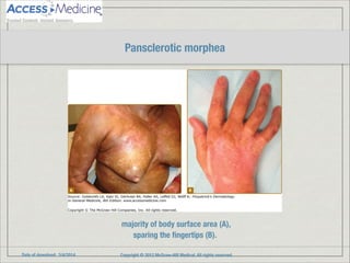 Date of download: 3/4/2014 Copyright © 2012 McGraw-Hill Medical. All rights reserved.
majority of body surface area (A),
sparing the ﬁngertips (B).
Pansclerotic morphea
 