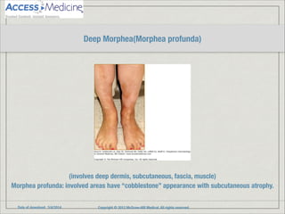 Date of download: 3/4/2014 Copyright © 2012 McGraw-Hill Medical. All rights reserved.
(involves deep dermis, subcutaneous, fascia, muscle)
Morphea profunda: involved areas have “cobblestone” appearance with subcutaneous atrophy.
Deep Morphea(Morphea profunda)
 