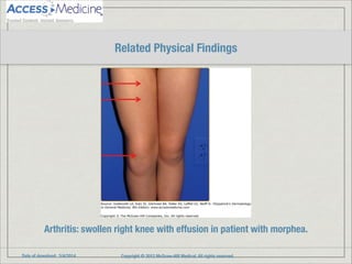 Date of download: 3/4/2014 Copyright © 2012 McGraw-Hill Medical. All rights reserved.
Arthritis: swollen right knee with effusion in patient with morphea.
Related Physical Findings
 