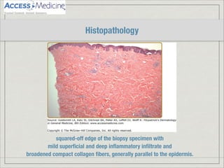 squared-off edge of the biopsy specimen with
mild superﬁcial and deep inﬂammatory inﬁltrate and
broadened compact collagen ﬁbers, generally parallel to the epidermis.
Histopathology
 