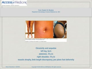 Date of download: 3/4/2014 Copyright © 2012 McGraw-Hill Medical. All rights reserved.
Chronicity and sequelae
left leg, 5y/o
abdomen, 16 y/o
right shoulder, 19 y/o
muscle atrophy, limb length discrepancy, pes plans foot deformity
From: Chapter 64. Morphea
Fitzpatrick's Dermatology in General Medicine, 8e, 2012
!
 