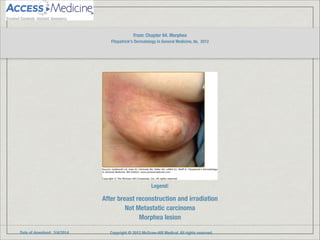 Date of download: 3/4/2014 Copyright © 2012 McGraw-Hill Medical. All rights reserved.
After breast reconstruction and irradiation
Not Metastatic carcinoma
Morphea lesion
Legend:
From: Chapter 64. Morphea
Fitzpatrick's Dermatology in General Medicine, 8e, 2012
!
 