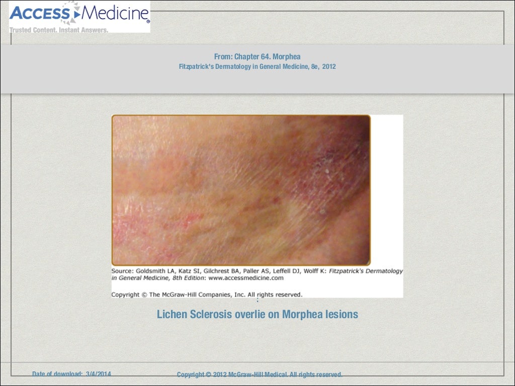 Morphea
