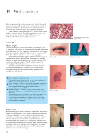 92
Like the pyogenic bacteria, viruses produce local lesions and
may also cause a widespread reaction to the infection such as
erythema multiforme. However, the clinical manifestations of
common viral infections of the skin are easily recognised.
Local infective lesions caused by DNA viruses which can be
isolated from the lesions themselves include the herpes and
pox virus groups. In patients with AIDS chronic and
widespread viral infections of the skin occur.
Herpes
Herpes simplex
The herpes simplex virus consists of two viral subtypes. Type I
is associated with lesions on the face and fingers and sometimes
genital lesions. Type II is associated almost entirely with genital
infections. Recurrent episodes of infection are common, with
both due to latent infection of sensory nerve ganglia.
Primary herpes simplex (type I) infection usually occurs in
or around the mouth, with variable involvement of the face.
Lesions are small vesicles which crust over and heal but there
may be considerable malaise. Type II infection affects the
external genitalia and waist area.
Recurrent infections are shorter lived (three to five days),
occur in the distribution of a sensory nerve on the face or
genitalia, and may be triggered by a variety of stimuli from
sunlight to febrile illness.
19 Viral infections
Herpes simplex—points to note
• The initial vesicular stage may not be seen in genital lesions,
which present as painful ulcers or erosions
• There is usually a history of preceding itching and tenderness
• The most rapid methods of detecting virus from scrapings
from the base of the ulcer are electronmicroscopy,
immunofluorescence, or PCR
• Genital herpes in a pregnant woman carries a great risk of
ophthalmic infection of the infant. Caesarean section may be
indicated
• “Eczema herpeticum” or “Kaposi’s varicelliform eruption” are
terms applied to severe cutaneous and, less commonly,
systemic, infection with herpes virus in patients with atopic
eczema and some other skin conditions. Treatment is with
oral or parenteral aciclovir
Herpes zoster
Varicella zoster virus (VZV) causes both chickenpox, the primary
illness, and herpes zoster, which follows reactivation of the virus
in the nerve ganglia. In zoster, pain, fever, and malaise may
occur before erythematous papules develop in the area of the
affected dermatome—most commonly in the thoracic area.
Vesicles develop over several days, crusting over as they resolve.
Secondary bacterial infection is common. Some patients develop
episodes of pain in the affected area—postherpetic neuralgia
after clearance of the rash. Skin lesions and nasopharyngeal
secretions can transmit chickenpox.
Molluscum inclusion bodies
(a pox virus)
Herpes of lips Inoculation herpes
Herpes simplex
Eczema herpeticum
Herpes zoster Herpes zoster
 
