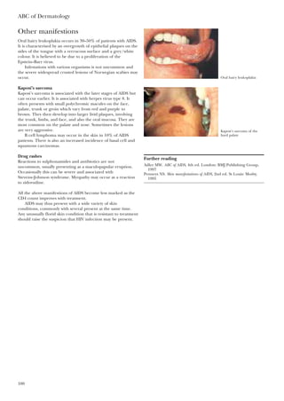 ABC of Dermatology
100
Other manifestions
Oral hairy leukoplakia occurs in 30–50% of patients with AIDS.
It is characterised by an overgrowth of epithelial plaques on the
sides of the tongue with a verrucous surface and a grey/white
colour. It is believed to be due to a proliferation of the
Epstein–Barr virus.
Infestations with various organisms is not uncommon and
the severe widespread crusted lesions of Norwegian scabies may
occur.
Kaposi’s sarcoma
Kaposi’s sarcoma is associated with the later stages of AIDS but
can occur earlier. It is associated with herpes virus type 8. It
often presents with small polychromic macules on the face,
palate, trunk or groin which vary from red and purple to
brown. They then develop into larger livid plaques, involving
the trunk, limbs, and face, and also the oral mucosa. They are
most common on the palate and nose. Sometimes the lesions
are very aggressive.
B cell lymphoma may occur in the skin in 10% of AIDS
patients. There is also an increased incidence of basal cell and
squamous carcinomas.
Drug rashes
Reactions to sulphonamides and antibiotics are not
uncommon, usually presenting as a maculopapular eruption.
Occasionally this can be severe and associated with
Stevens–Johnson syndrome. Myopathy may occur as a reaction
to zidovudine.
All the above manifestions of AIDS become less marked as the
CD4 count improves with treatment.
AIDS may thus present with a wide variety of skin
conditions, commonly with several present at the same time.
Any unusually florid skin condition that is resistant to treatment
should raise the suspicion that HIV infection may be present.
Further reading
Adler MW. ABC of AIDS, 4th ed. London: BMJ Publishing Group,
1997
Penneys NS. Skin manifestations of AIDS, 2nd ed. St Louis: Mosby,
1995
Oral hairy leukoplakia
Kaposi’s sarcoma of the
hard palate
 